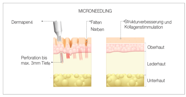 Aesthetik-Konzepte Marion Winter Nuernberg Micro Needling