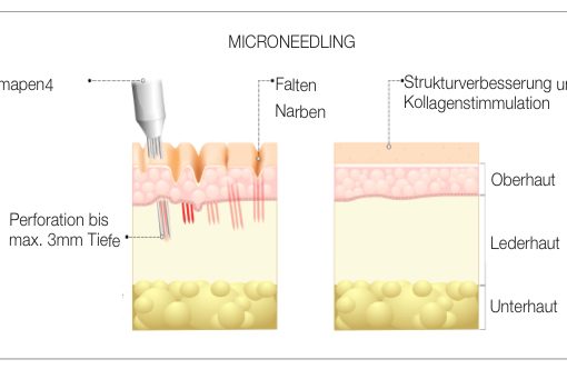 Micro Needling - Intensive Hauttherapie und Strukturverbesserung
