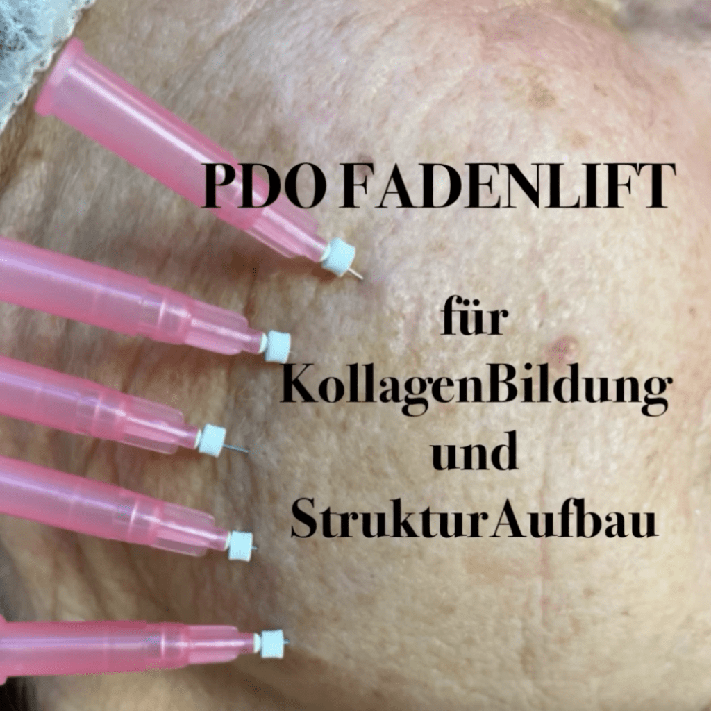 Fadenlift mit PDO Fäden - Stützt und strafft von Innen