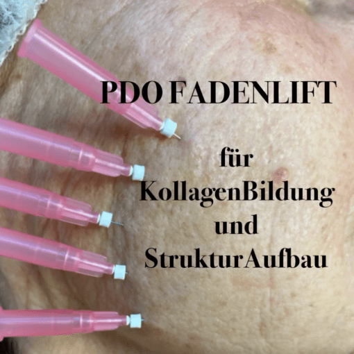 Fadenlift mit PDO Fäden - Stützt und strafft von Innen
