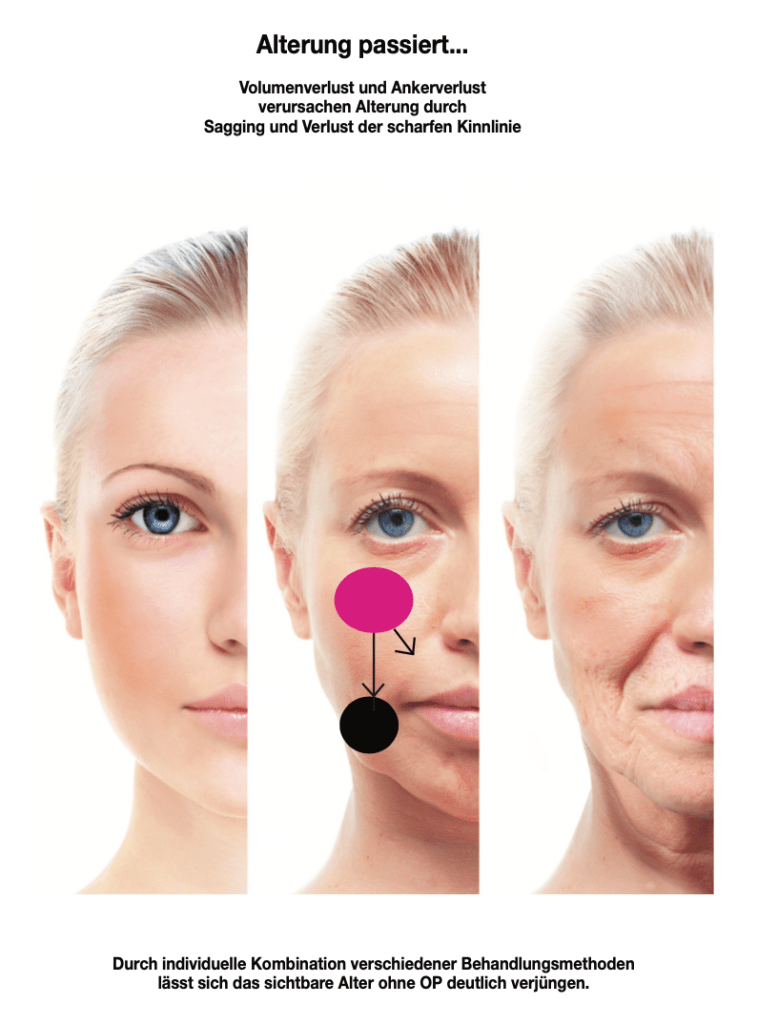 Gesichtsalterung - Falten