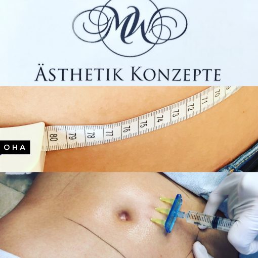 Lipolyse für Face- und Bodyforming