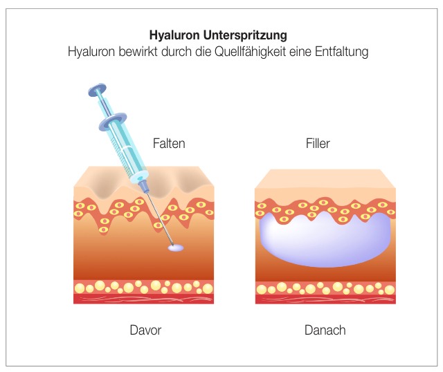 Schematische Darstellung einer Hyaluron-Unterspritzung zur Faltenbehandlung in Nürnberg mit Vorher-Nachher-Vergleich